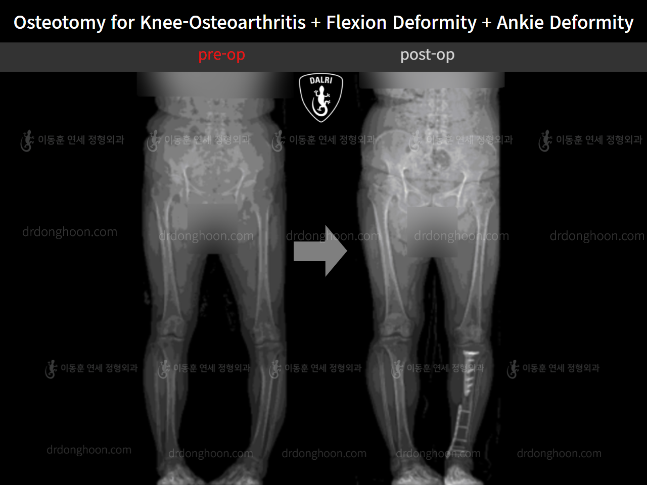 Before and after osteotomy for knee osteoarthritis, case 5315780, image 2, Dr. Donghoon institute (DALRI)