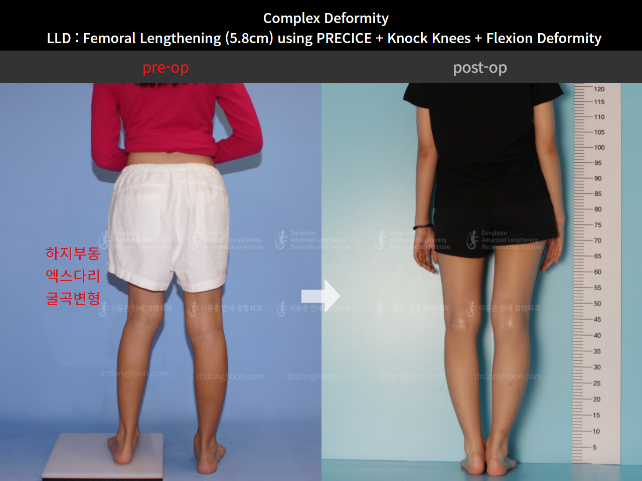 Before and after complex deformity, case 8790512, image 4, Dr. Donghoon institute (DALRI)