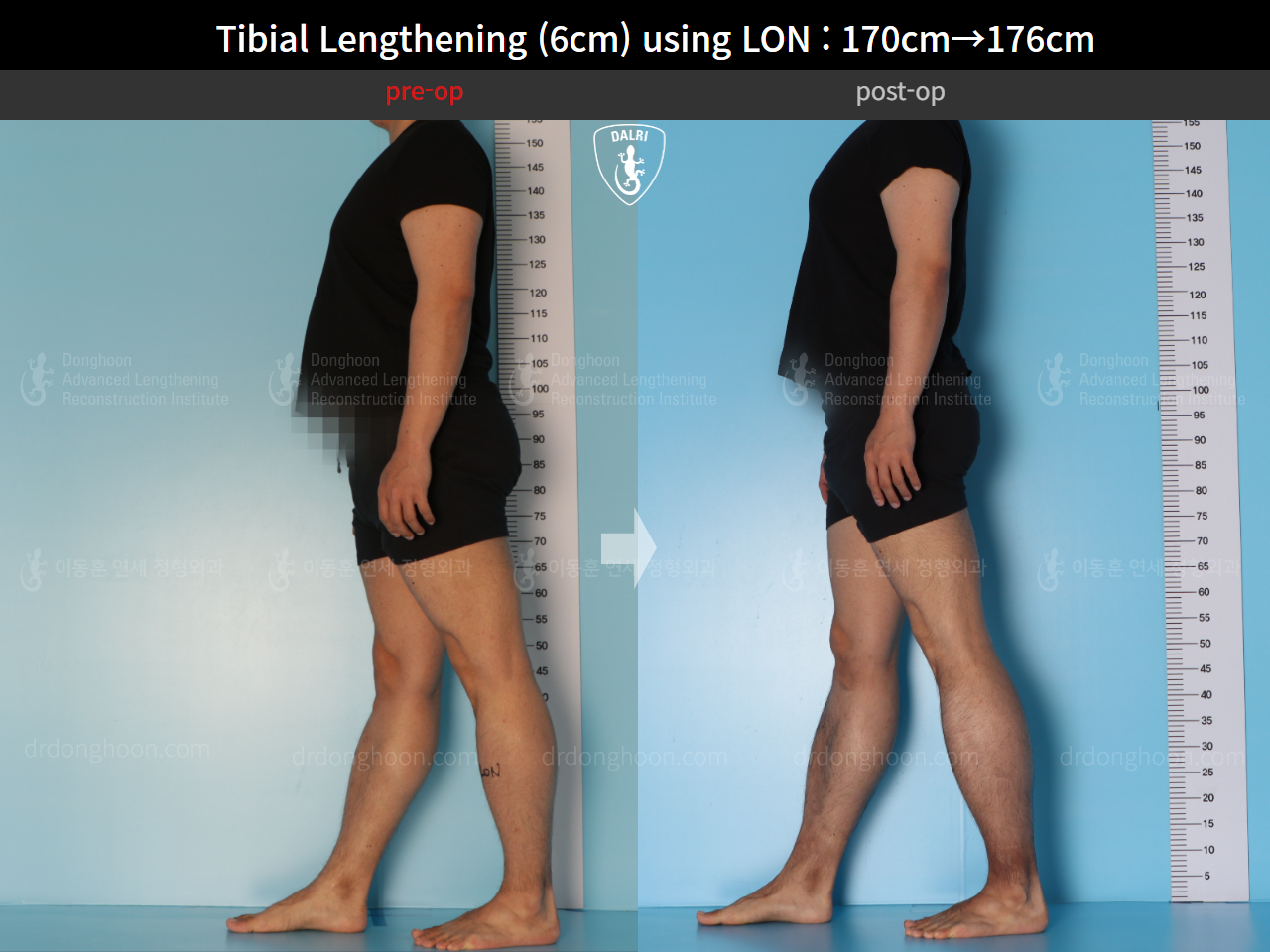 Before and after cll lon, case 15623962, image 5, Dr. Donghoon institute (DALRI)
