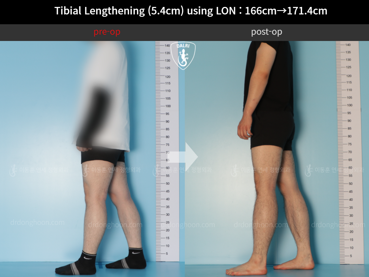 Before and after cll lon, case 11831572, image 3, Dr. Donghoon institute (DALRI)