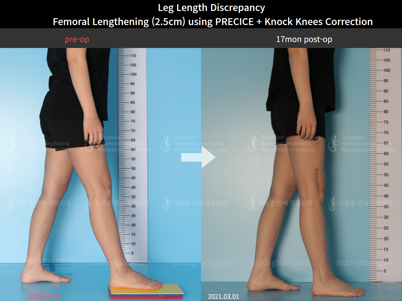 Before and after adult lld, case 8385191, image 4, Dr. Donghoon institute (DALRI)
