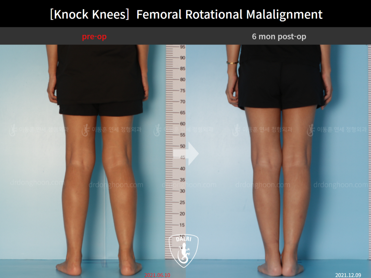 Before and after adult knock knees, case 9163067, image 4, Dr. Donghoon institute (DALRI)
