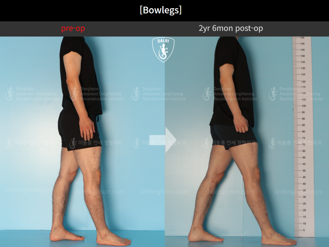 Before and after adult bowlegs, case 11037119, image 5, Dr. Donghoon institute (DALRI)