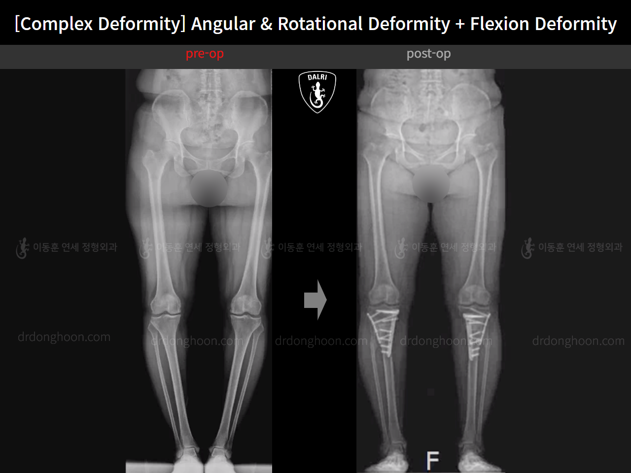 Before and after adult bowlegs, case 16781344, image 12, Dr. Donghoon institute (DALRI)