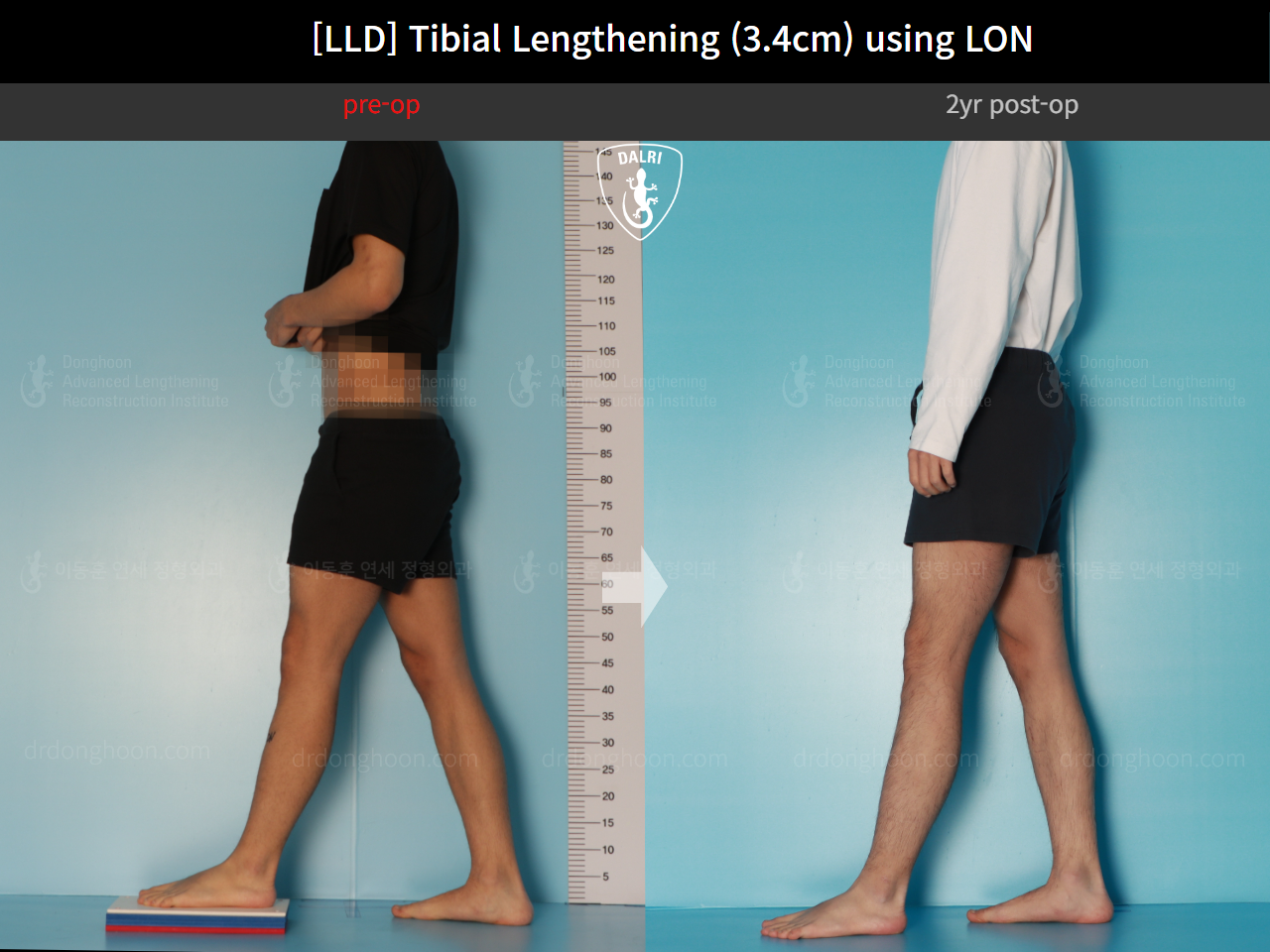 Before and after adult lld, case 17538143, image 4, Dr. Donghoon institute (DALRI)