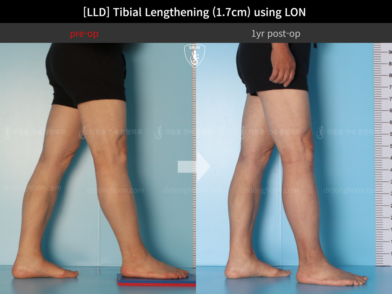 Before and after adult lld, case 13261805, image 6, Dr. Donghoon institute (DALRI)