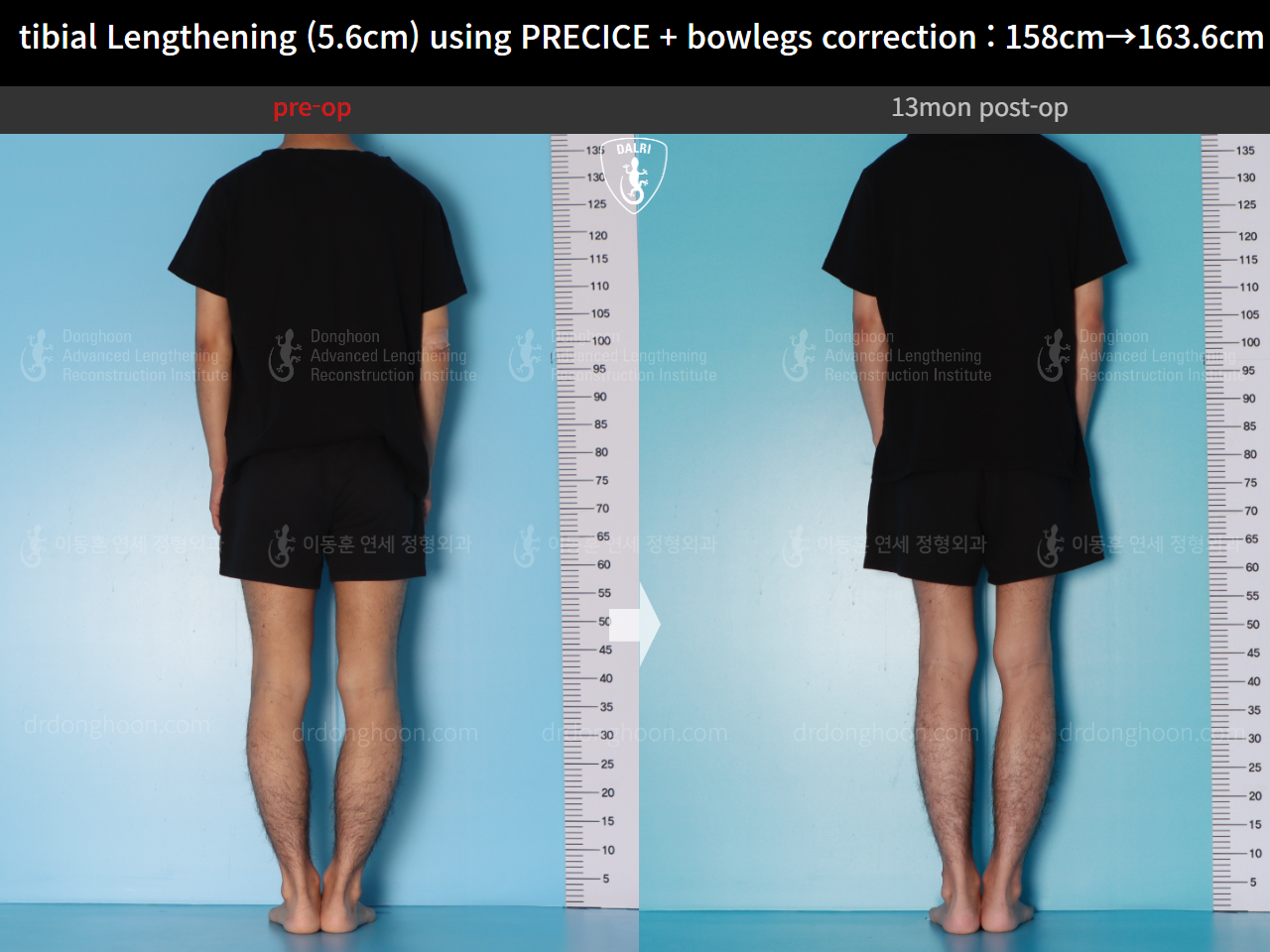 Before and after cll precice, case 16213622, image 3, Dr. Donghoon institute (DALRI)