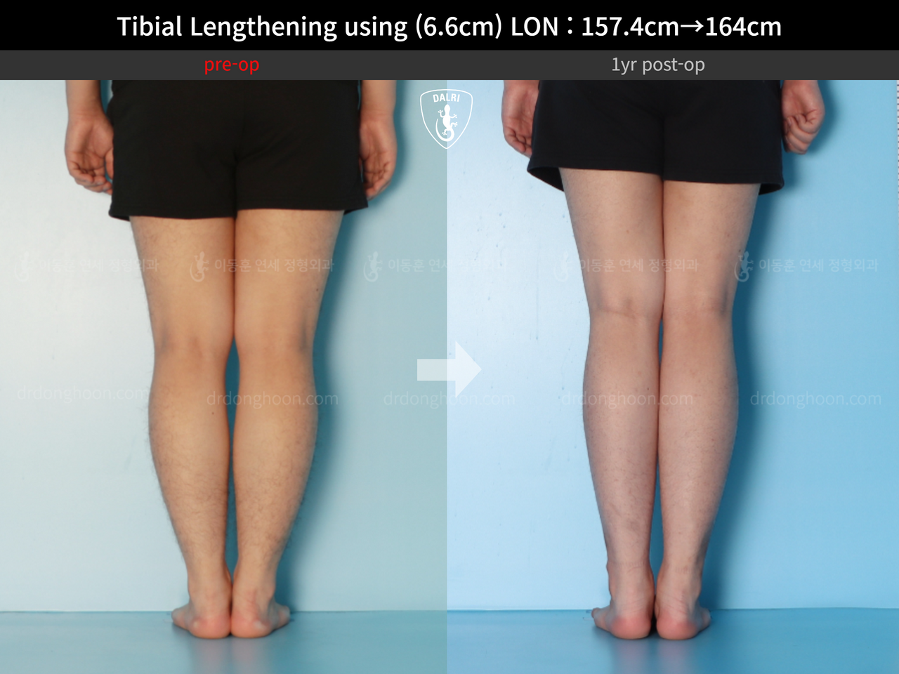 Before and after cll lon, case 13418098, image 6, Dr. Donghoon institute (DALRI)