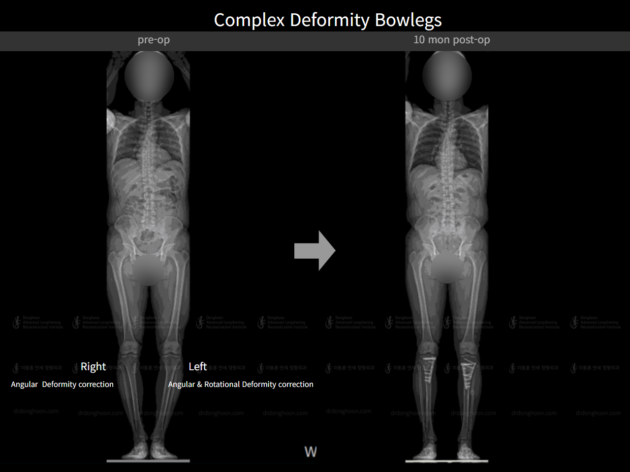 Before and after adult bowlegs, case 7809748, image 1, Dr. Donghoon institute (DALRI)