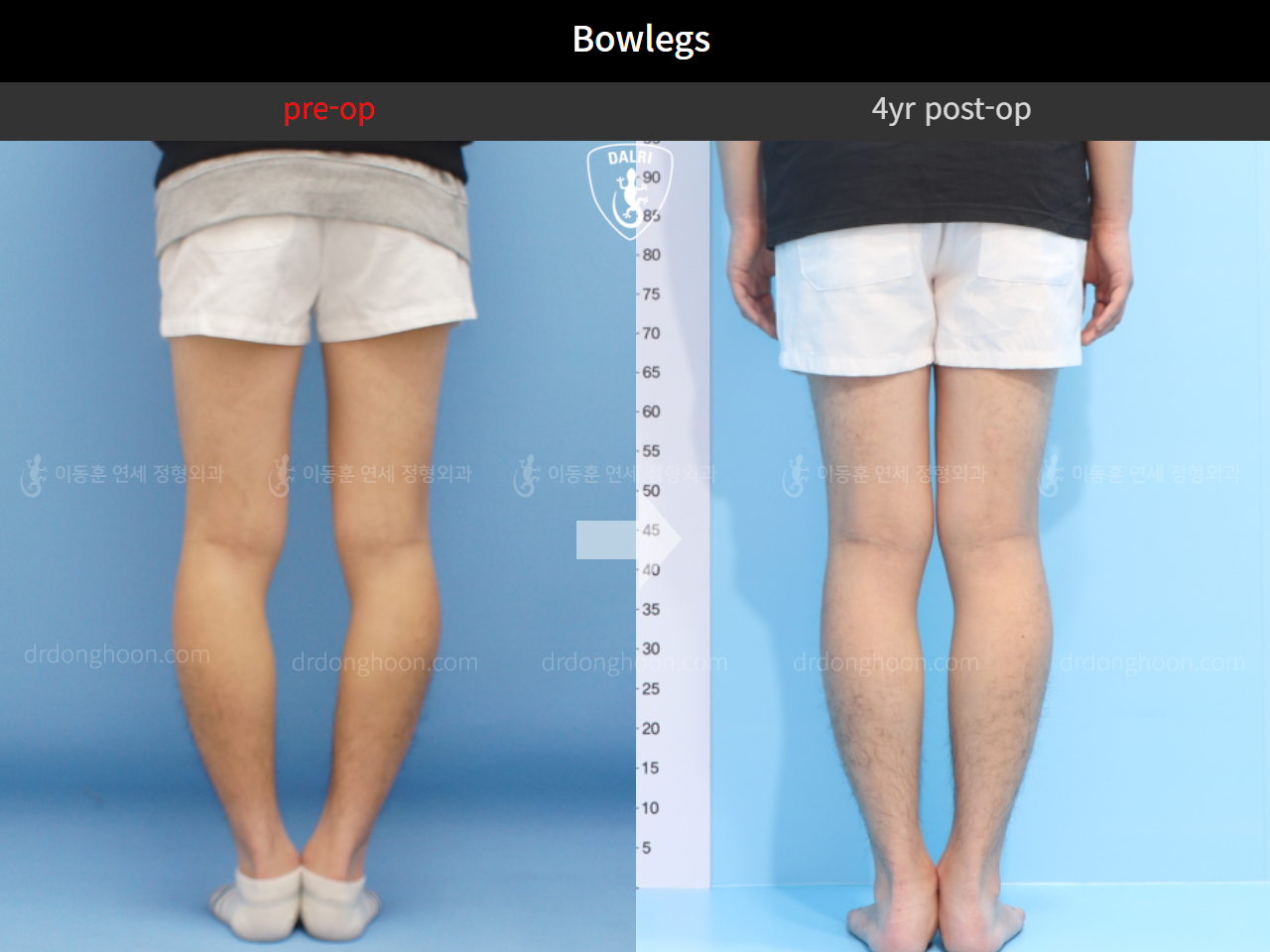 Before and after adult bowlegs, case 4311360, image 7, Dr. Donghoon institute (DALRI)