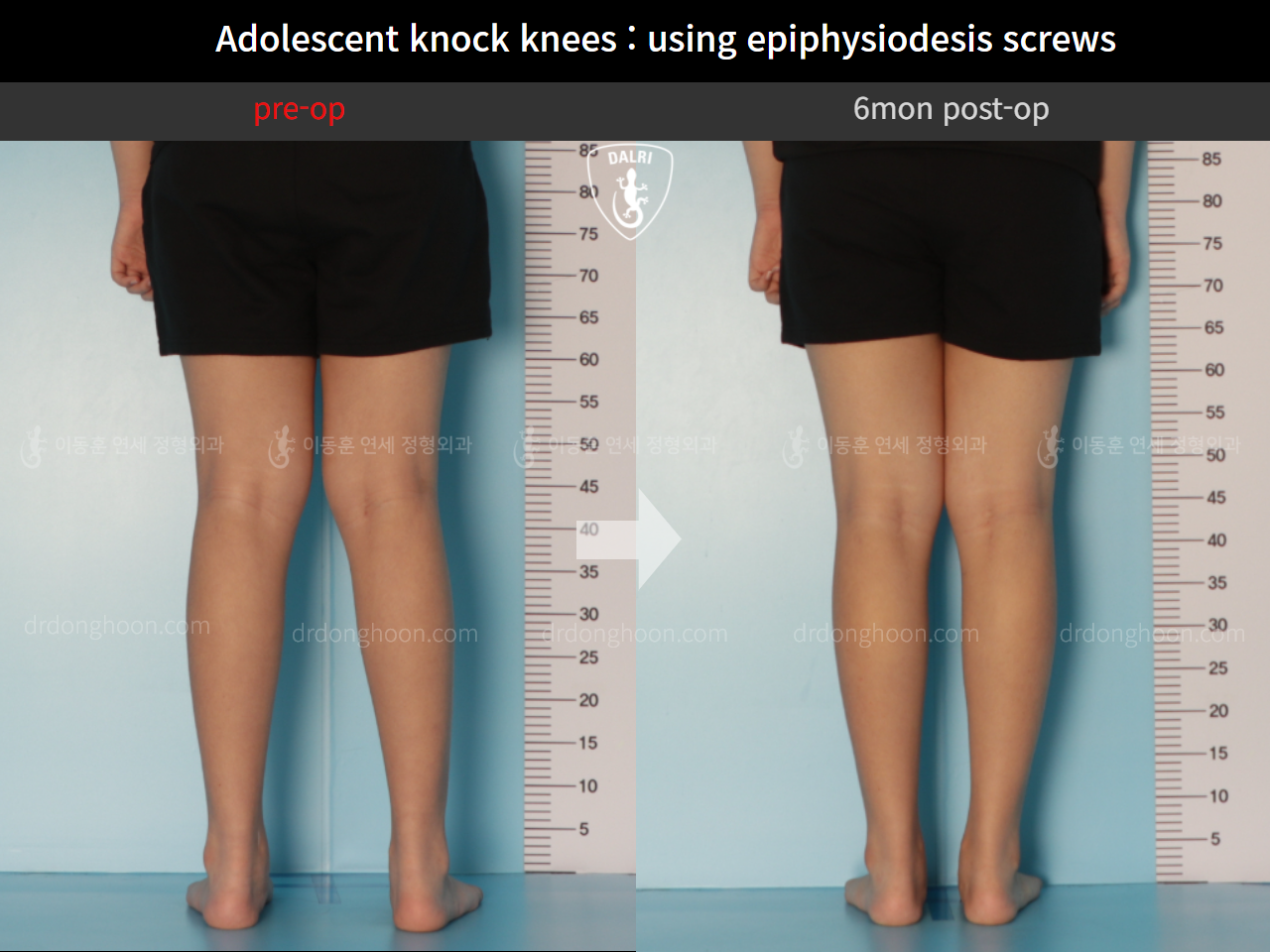 Before and after paediatric & adolescent knock knees, case 9626556, image 4, Dr. Donghoon institute (DALRI)