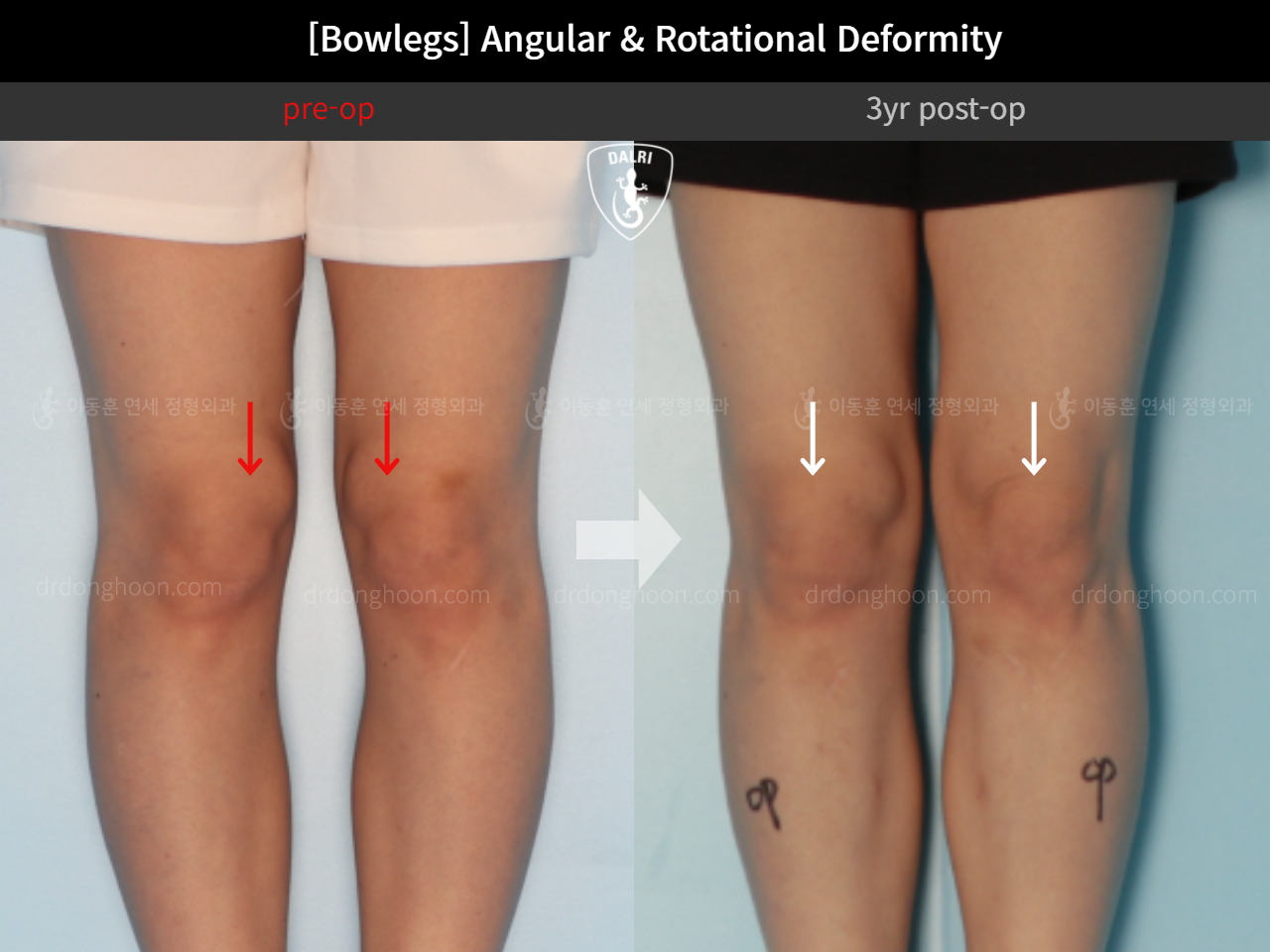 Before and after adult bowlegs, case 9678047, image 3, Dr. Donghoon institute (DALRI)