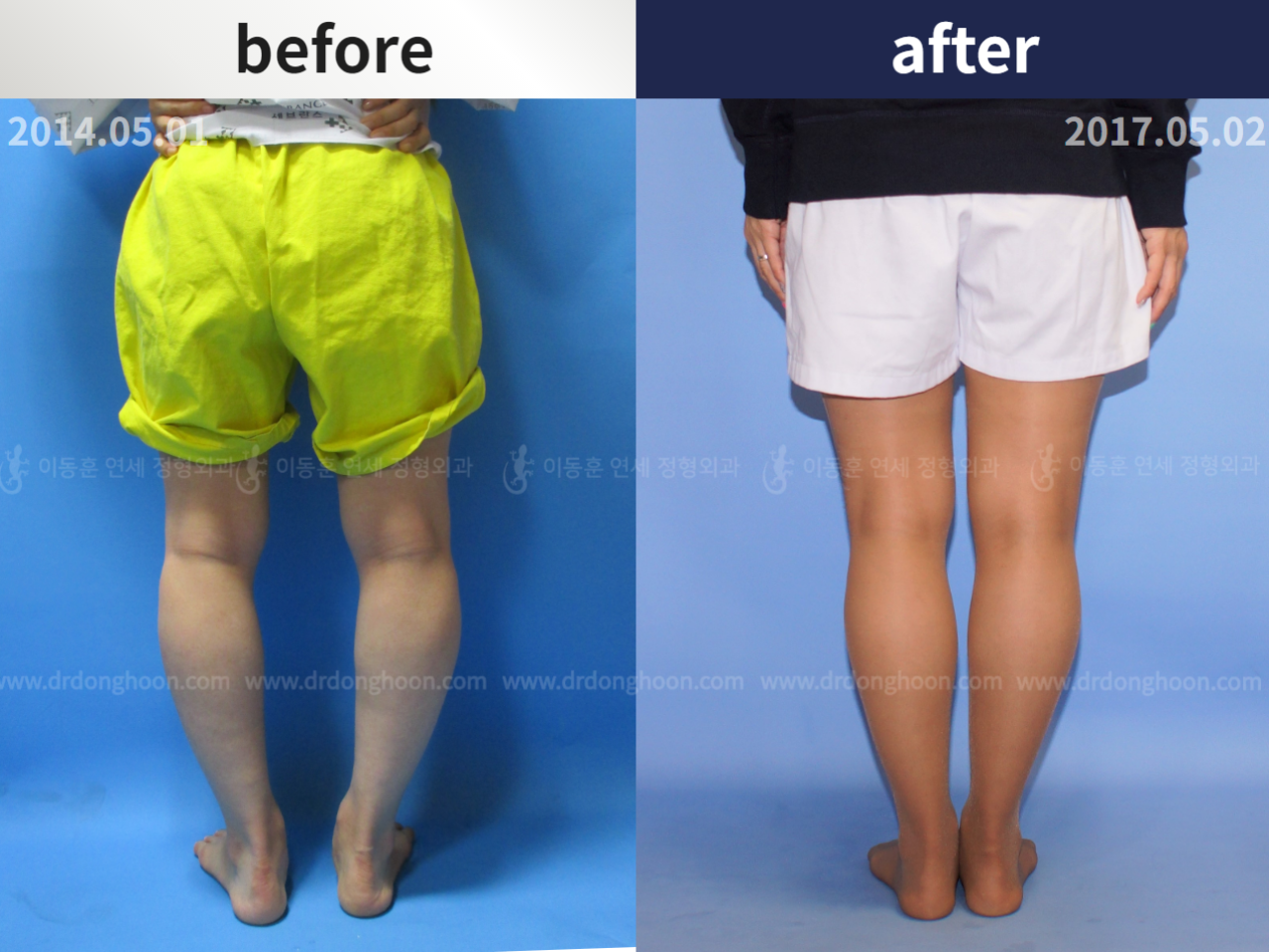 Before and after adult bowlegs, case 4764706, image 2, Dr. Donghoon institute (DALRI)