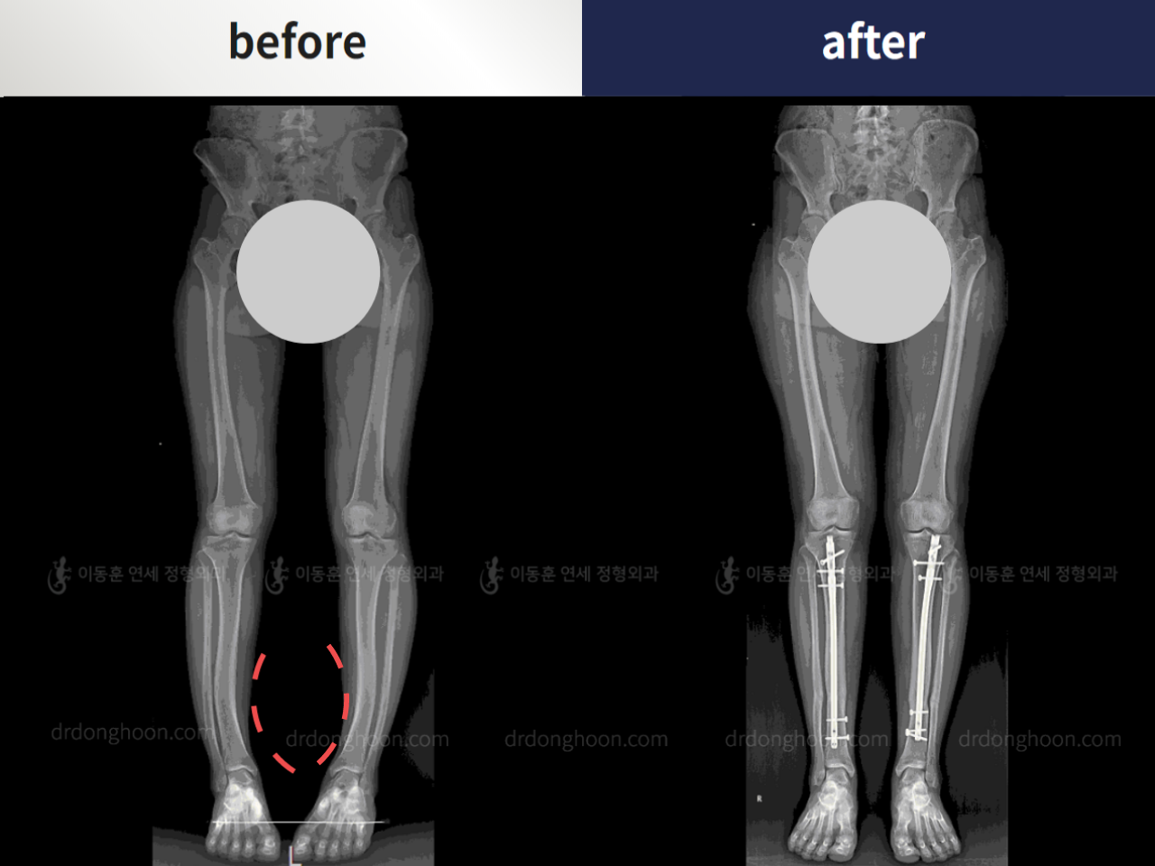 Before and after foot & ankle deformity, case 4248027, image 3, Dr. Donghoon institute (DALRI)