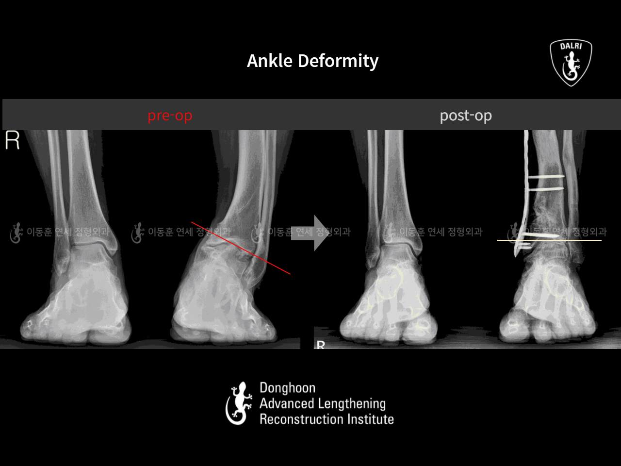 Before and after complex deformity, case 11230129, image 4, Dr. Donghoon institute (DALRI)