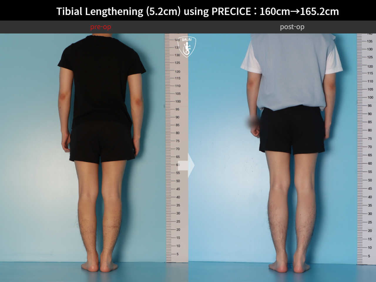 Before and after cll precice, case 27370351, image 2, Dr. Donghoon institute (DALRI)
