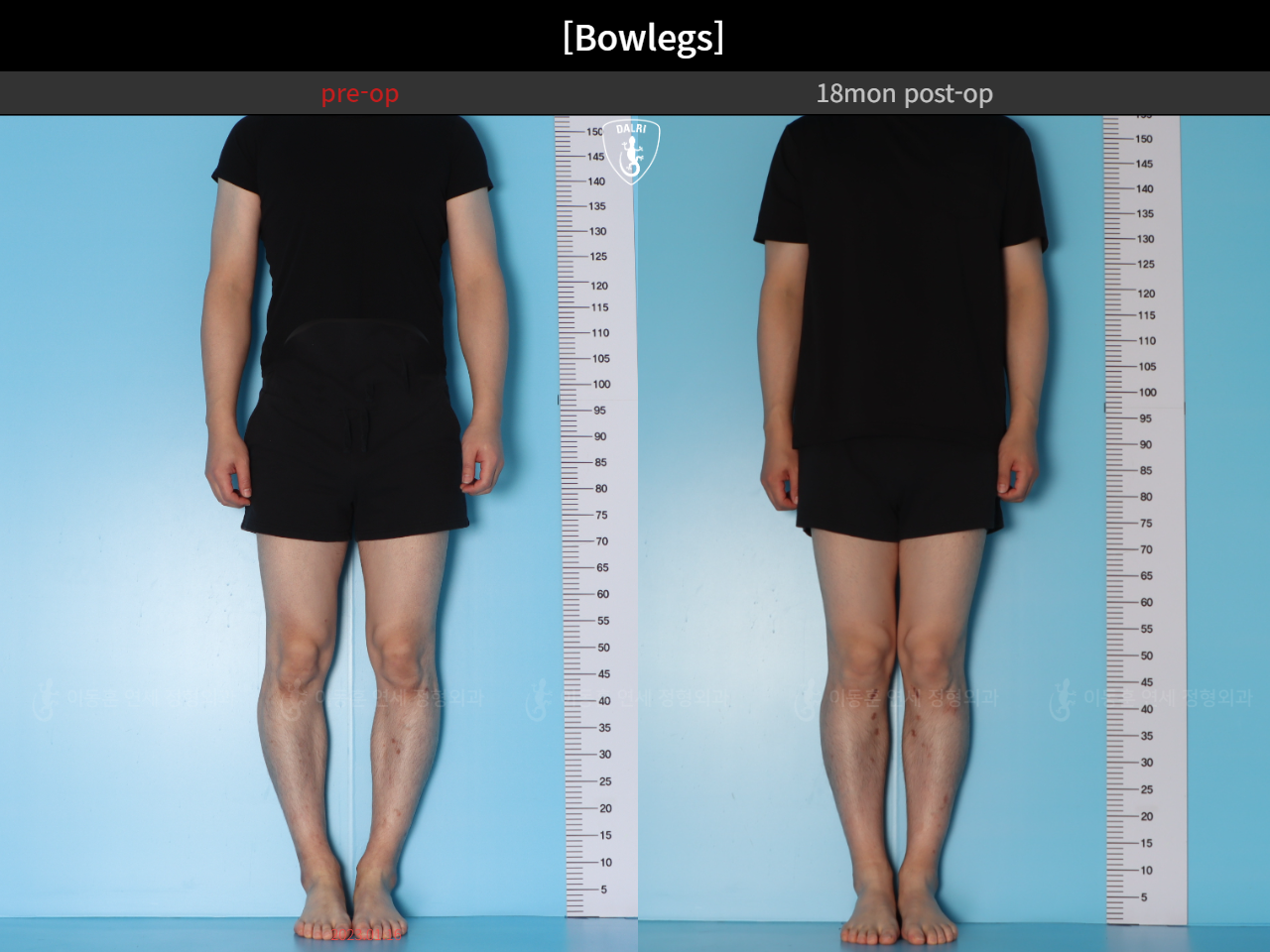 Before and after adult bowlegs, case 94769040, image 3, Dr. Donghoon institute (DALRI)