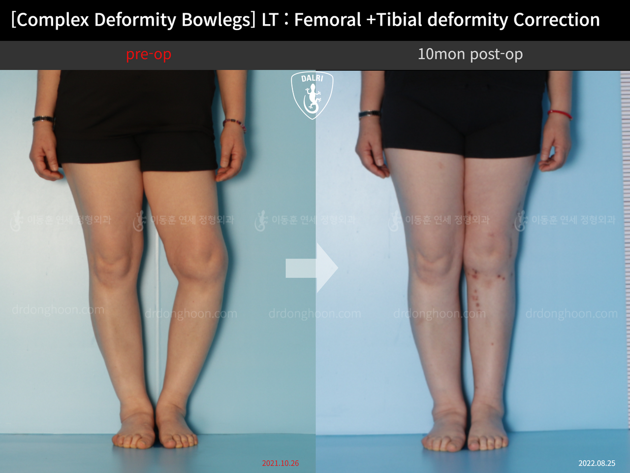 Before and after adult bowlegs, case 12790433, image 4, Dr. Donghoon institute (DALRI)