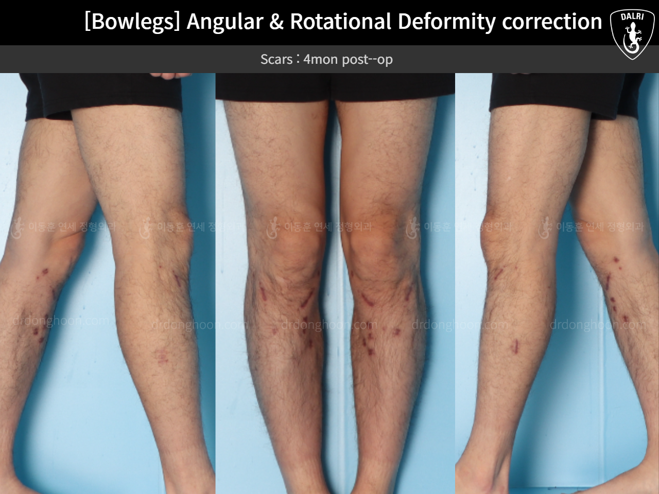 Before and after adult bowlegs, case 18306379, image 7, Dr. Donghoon institute (DALRI)