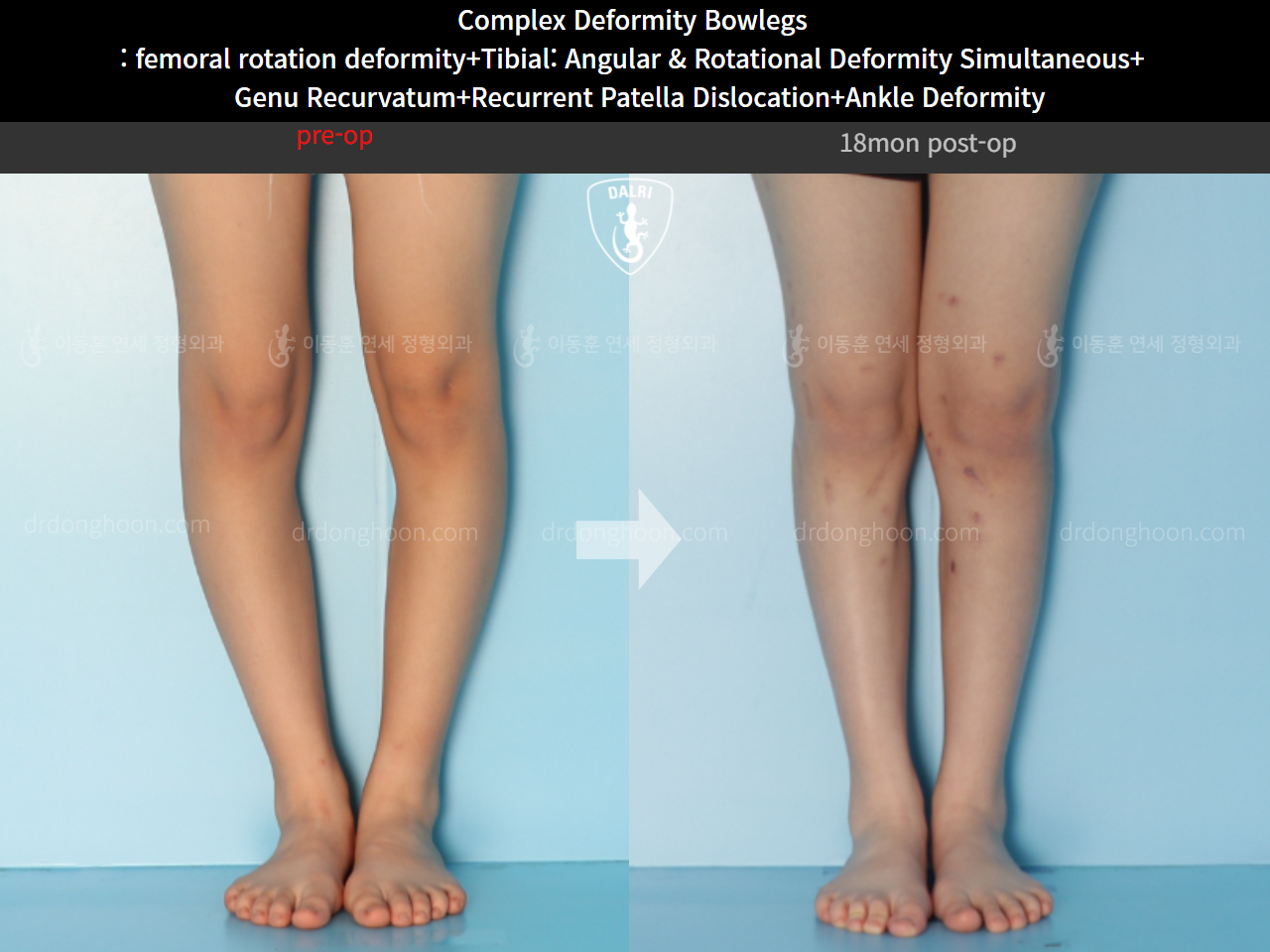 Before and after complex deformity, case 11244013, image 4, Dr. Donghoon institute (DALRI)
