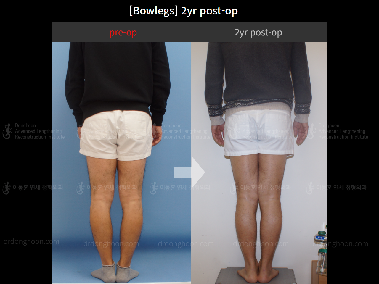 Before and after adult bowlegs, case 4311027, image 2, Dr. Donghoon institute (DALRI)