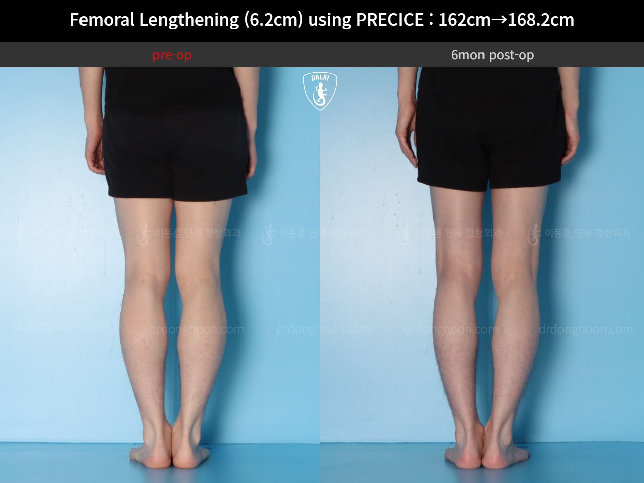 Before and after cll precice, case 15393865, image 10, Dr. Donghoon institute (DALRI)