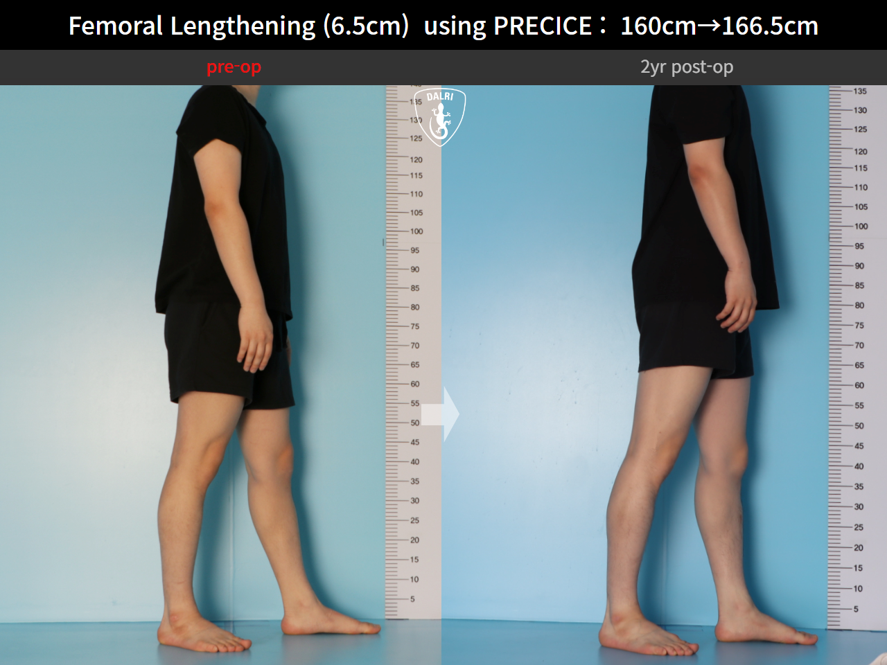 Before and after cll precice, case 27369651, image 6, Dr. Donghoon institute (DALRI)