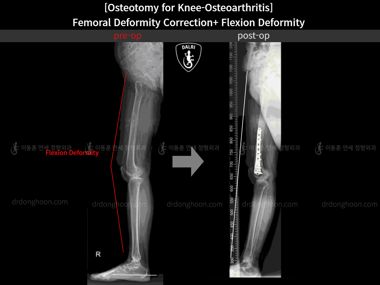 Before and after osteotomy for knee osteoarthritis, case 11380349, image 4, Dr. Donghoon institute (DALRI)