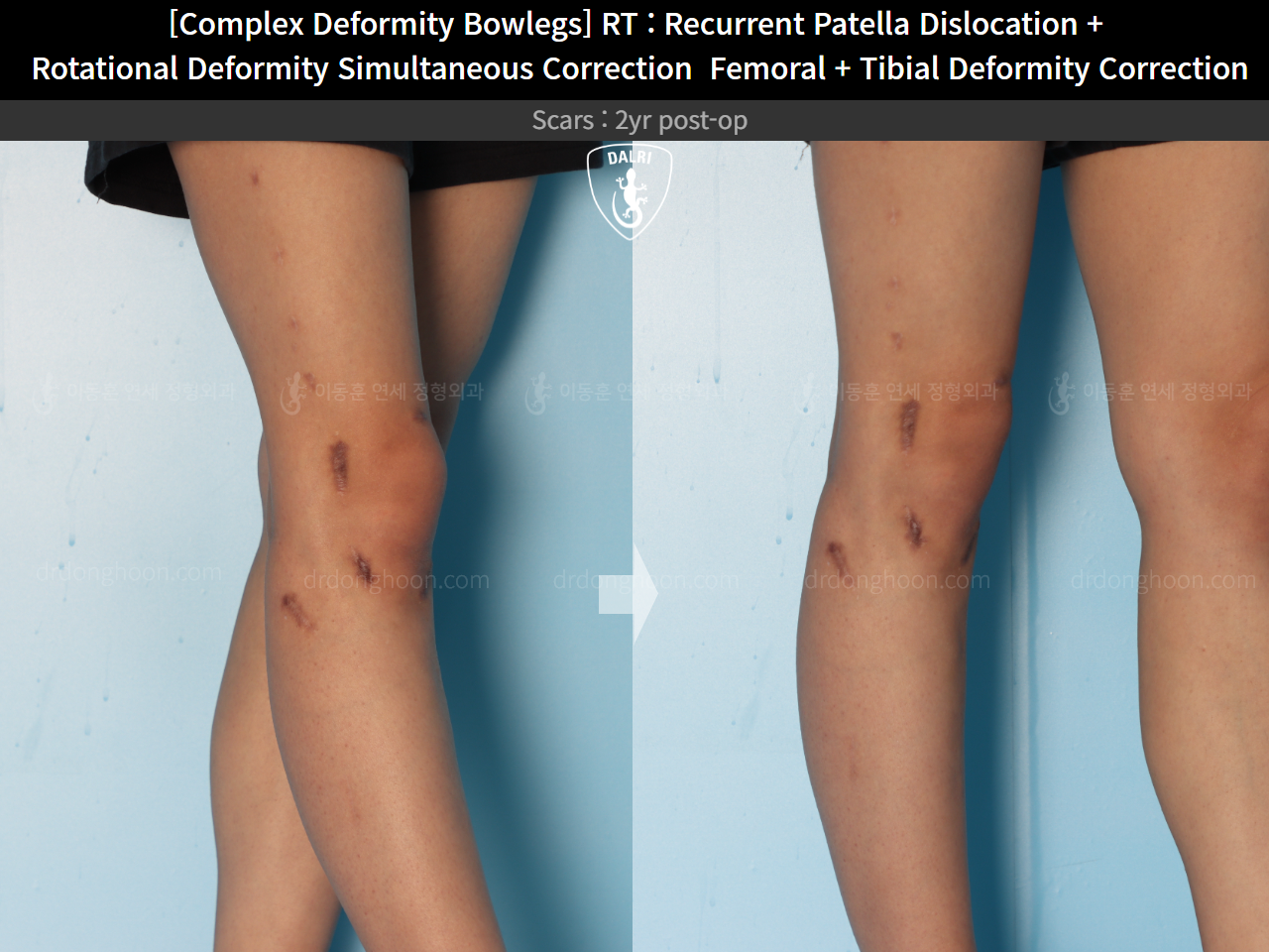 Before and after recurrent patella dislocation, case 14960900, image 8, Dr. Donghoon institute (DALRI)