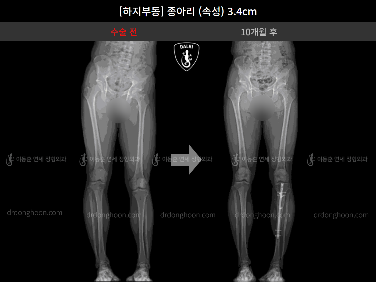 Before and after adult lld, case 4585742, image 8, Dr. Donghoon institute (DALRI)