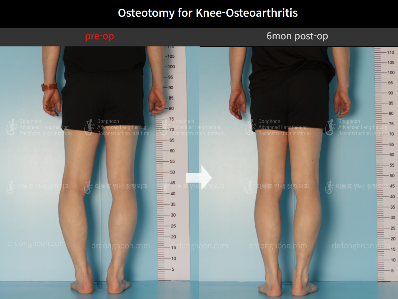 Before and after osteotomy for knee osteoarthritis, case 8796980, image 5, Dr. Donghoon institute (DALRI)