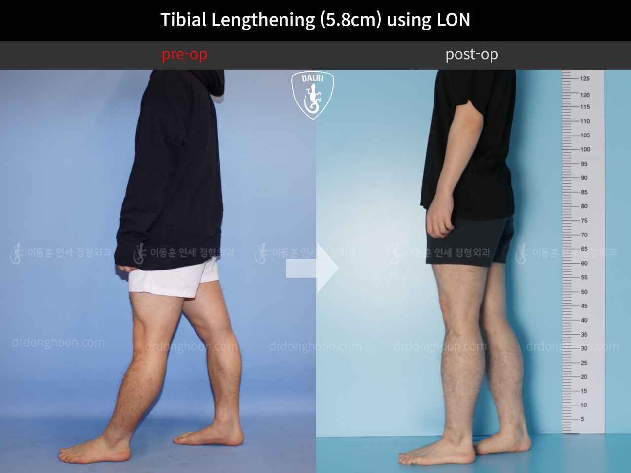 Before and after cll lon, case 4577732, image 3, Dr. Donghoon institute (DALRI)
