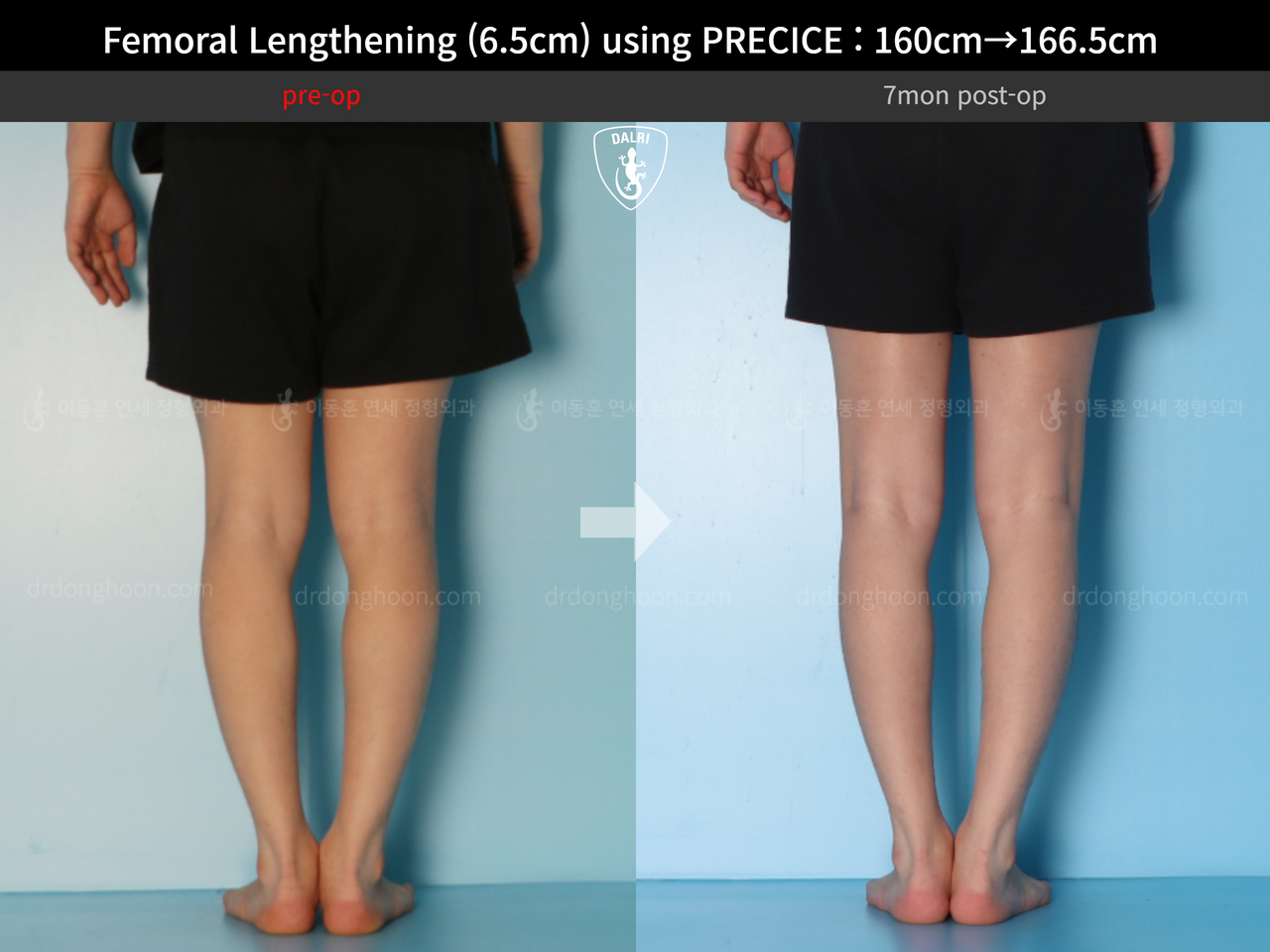 Before and after cll precice, case 13413485, image 8, Dr. Donghoon institute (DALRI)
