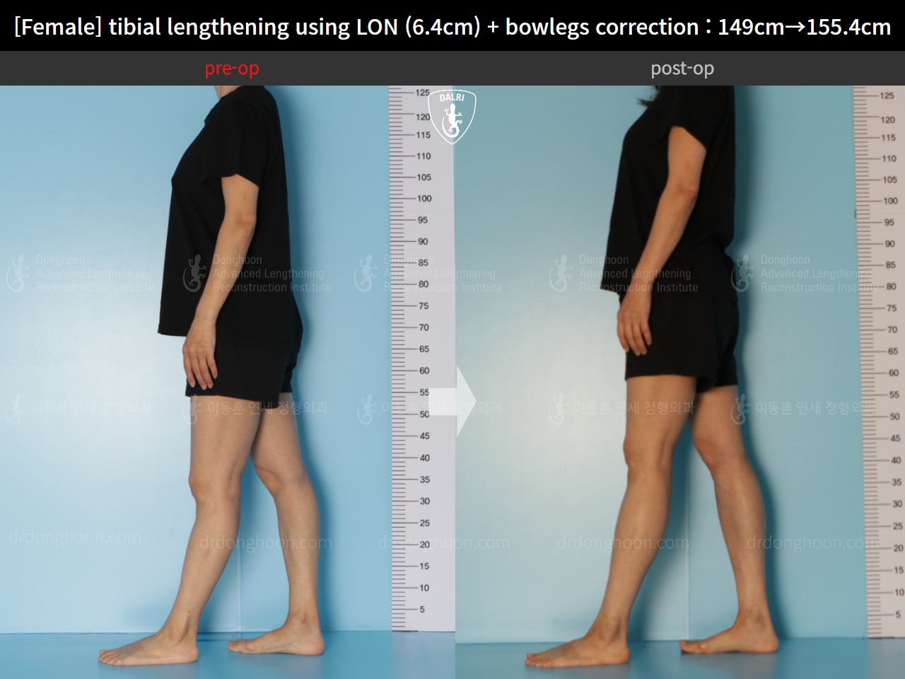 Before and after cll lon, case 15615051, image 4, Dr. Donghoon institute (DALRI)