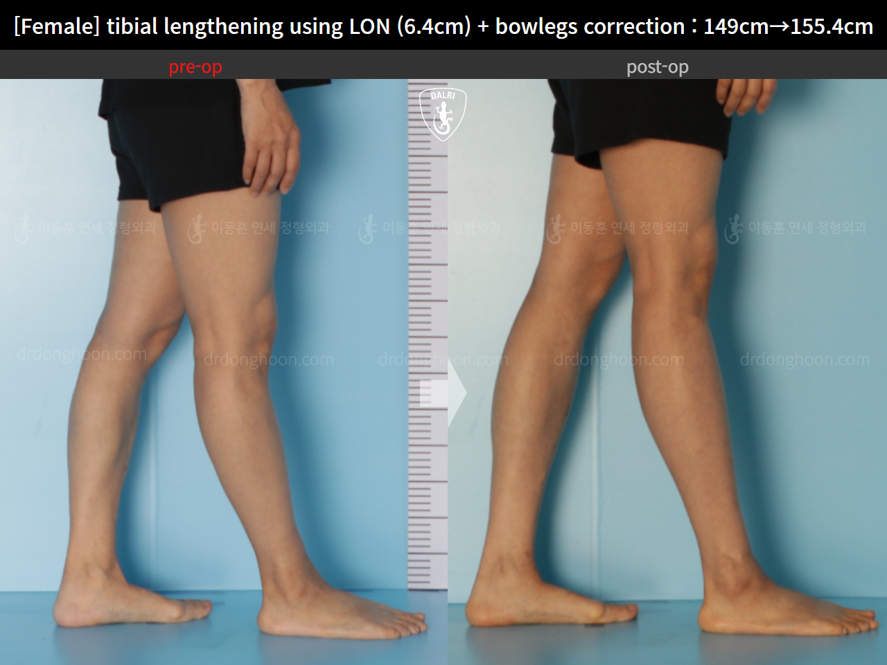 Before and after cll lon, case 15615051, image 7, Dr. Donghoon institute (DALRI)