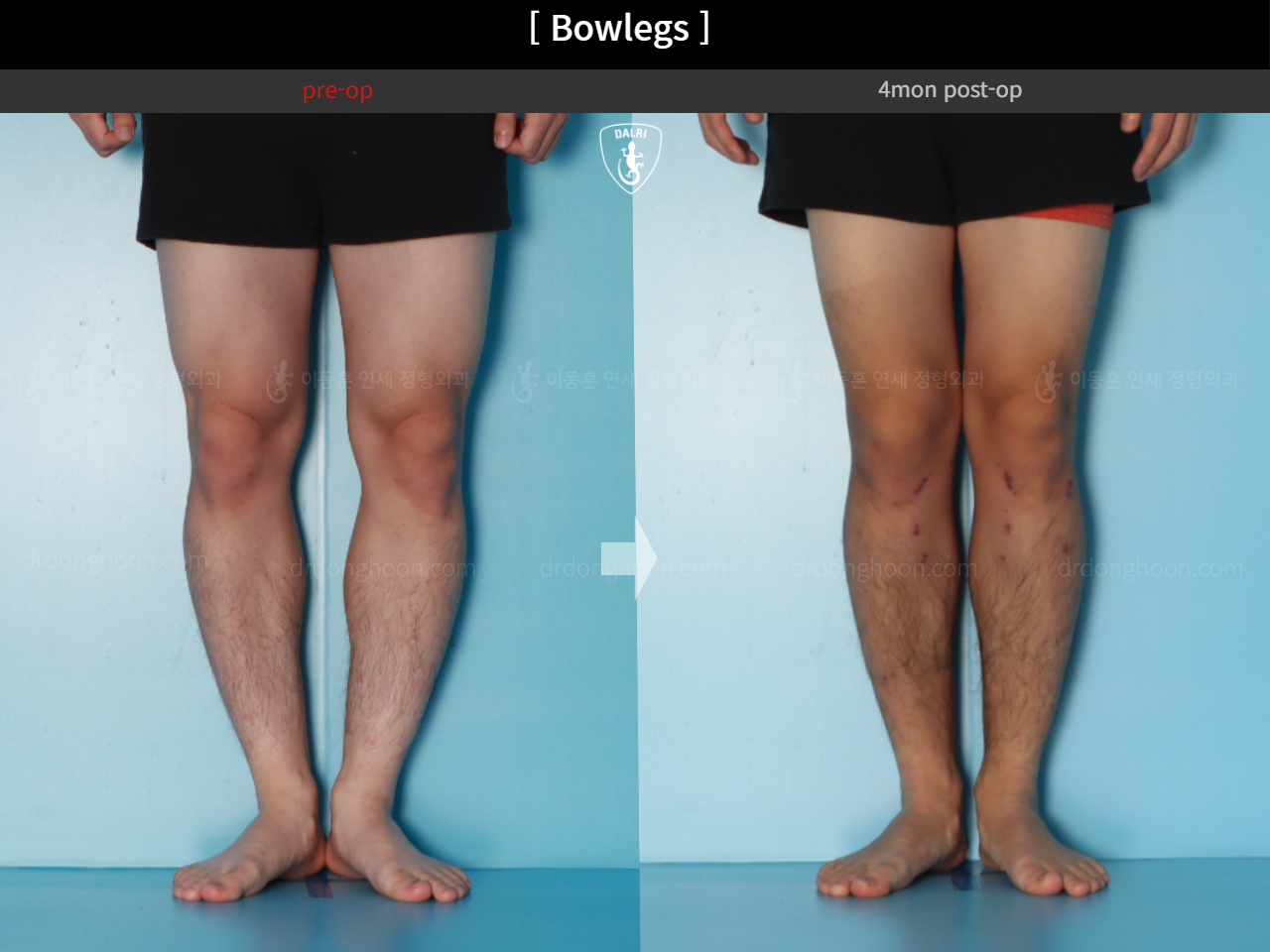 Before and after adult bowlegs, case 18479637, image 7, Dr. Donghoon institute (DALRI)