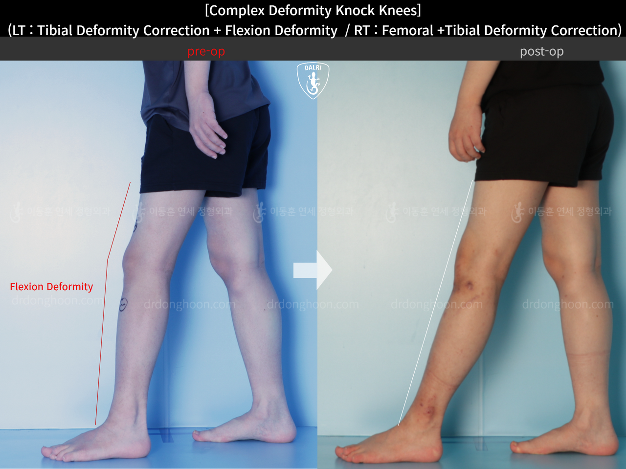 Before and after adult knock knees, case 14439339, image 8, Dr. Donghoon institute (DALRI)