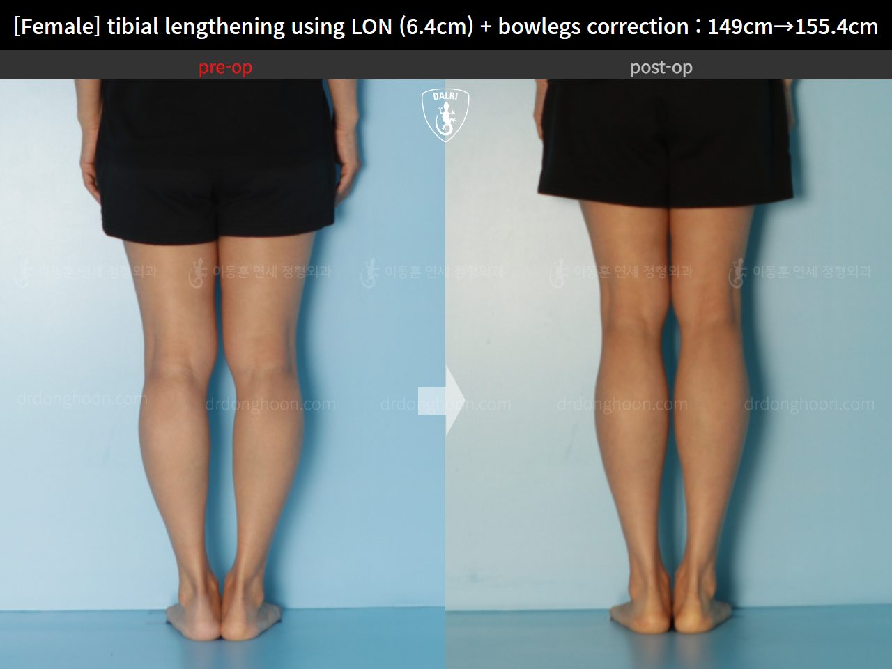 Before and after cll lon, case 15615051, image 6, Dr. Donghoon institute (DALRI)
