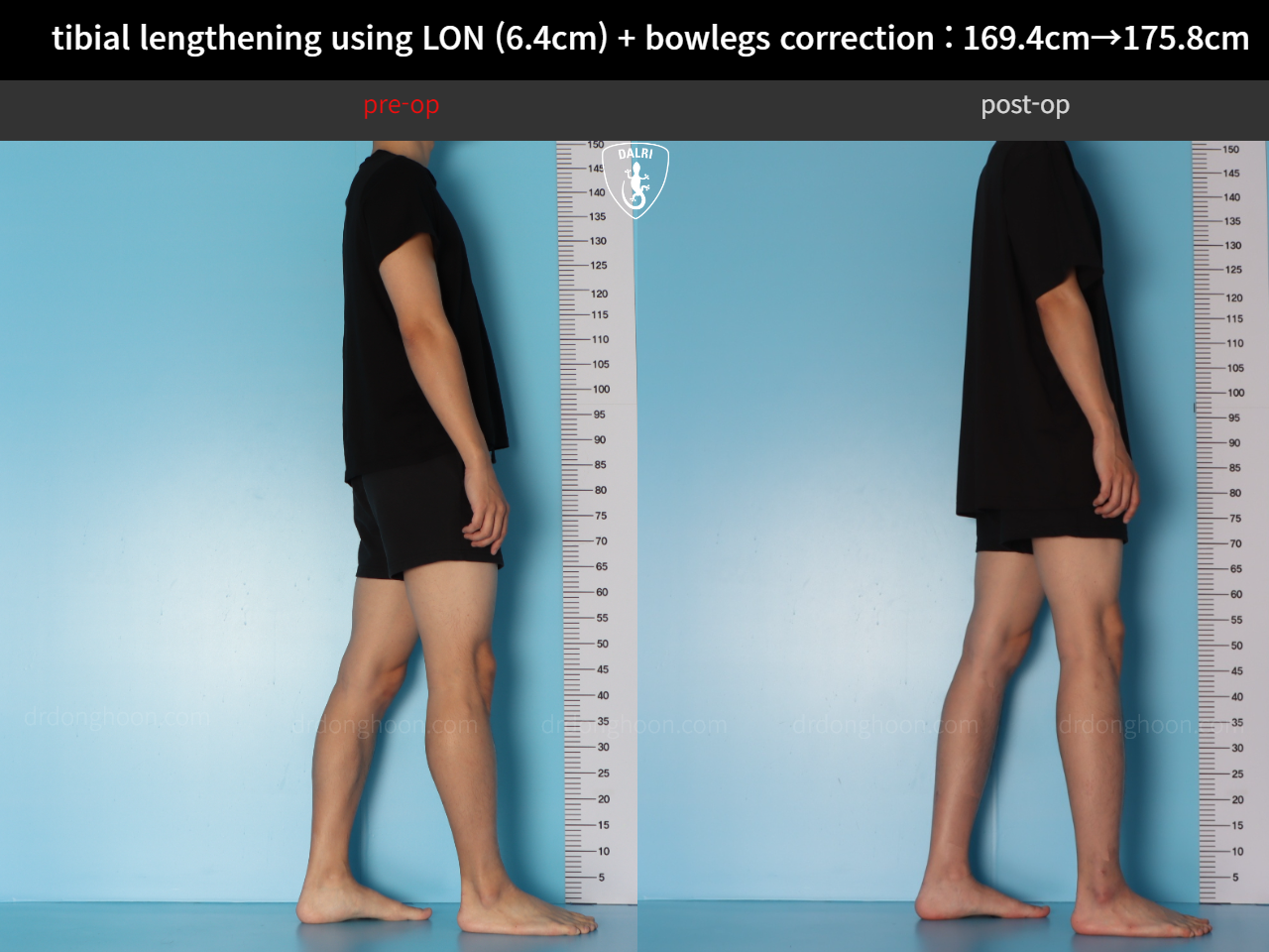 Before and after cll + deformity correction, case 36736776, image 3, Dr. Donghoon institute (DALRI)