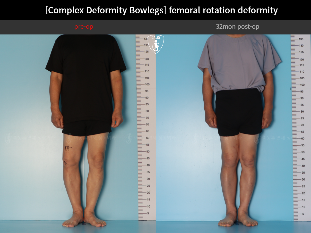 Before and after adult bowlegs, case 35242887, image 5, Dr. Donghoon institute (DALRI)