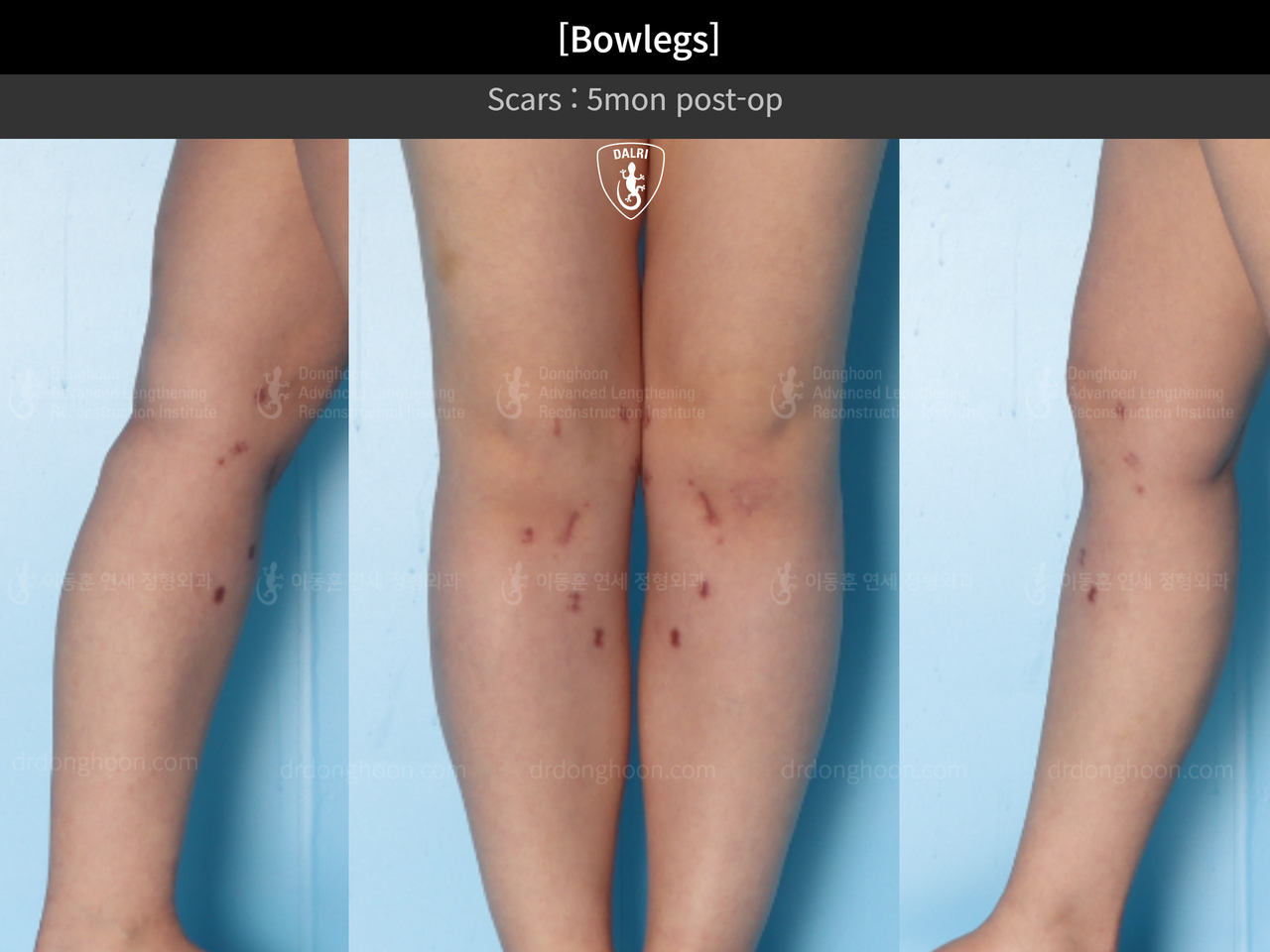 Before and after adult bowlegs, case 13212059, image 4, Dr. Donghoon institute (DALRI)