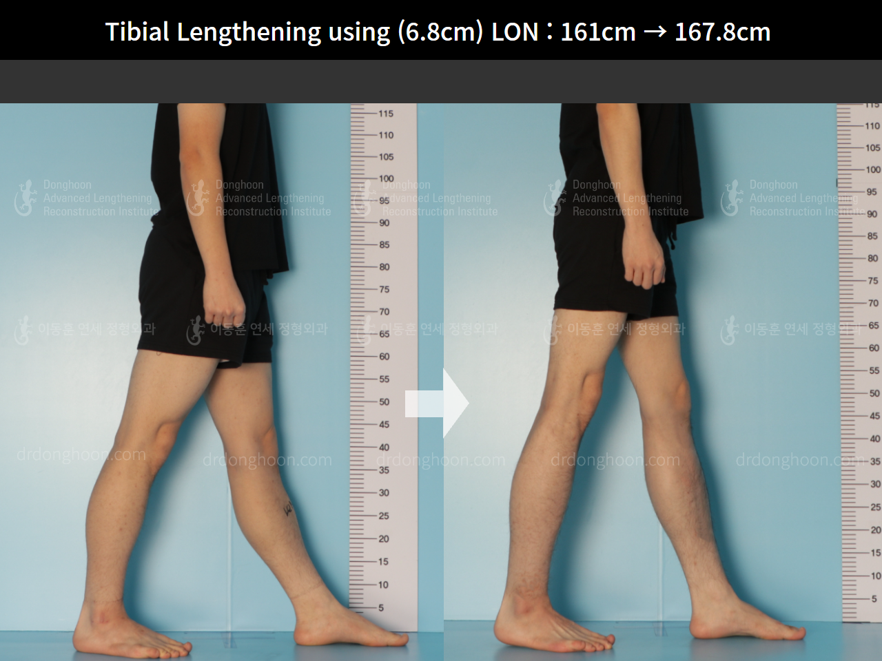 Before and after cll lon, case 8663720, image 8, Dr. Donghoon institute (DALRI)