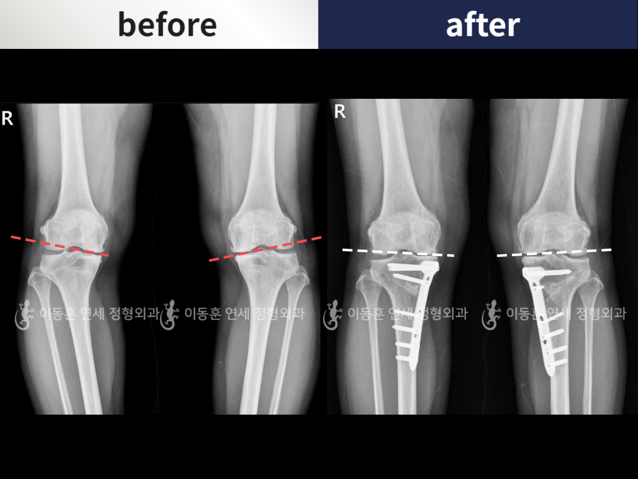 Before and after osteotomy for knee osteoarthritis, case 5968812, image 1, Dr. Donghoon institute (DALRI)