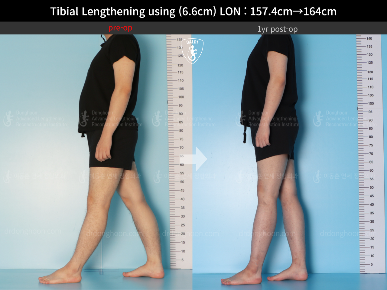 Before and after cll lon, case 13418098, image 4, Dr. Donghoon institute (DALRI)
