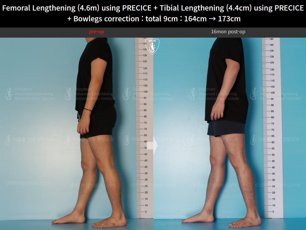 Before and after cll + deformity correction, case 16697522, image 8, Dr. Donghoon institute (DALRI)