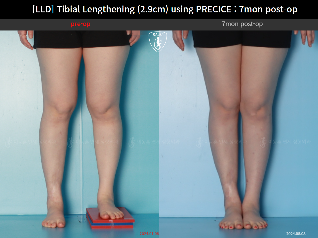 Before and after adult lld, case 62389039, image 5, Dr. Donghoon institute (DALRI)