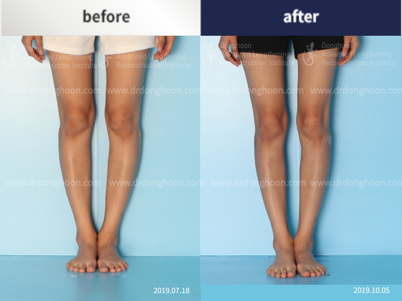 Before and after protruded fibular head, case 4248742, image 3, Dr. Donghoon institute (DALRI)