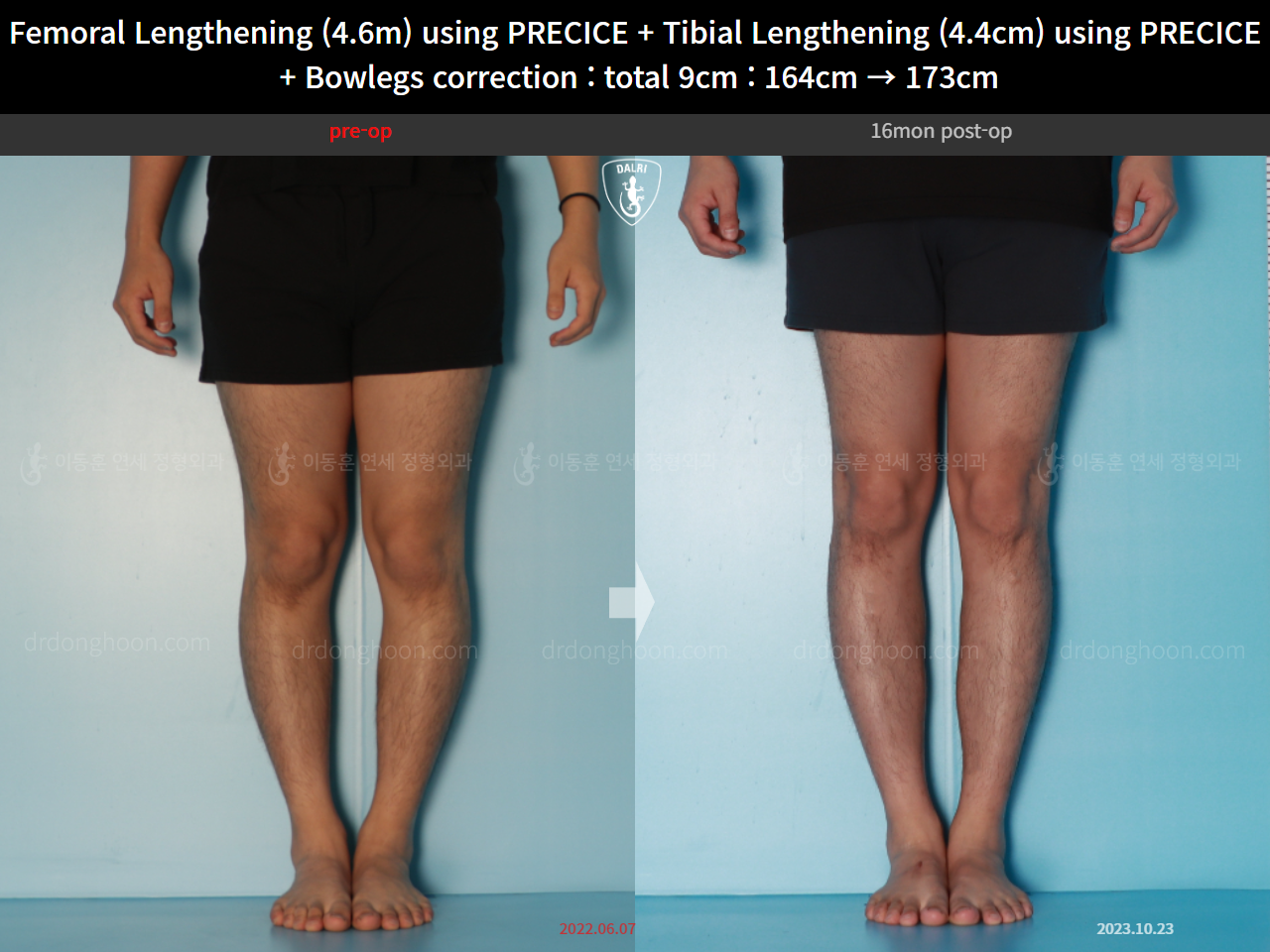 Before and after cll + deformity correction, case 16697522, image 9, Dr. Donghoon institute (DALRI)