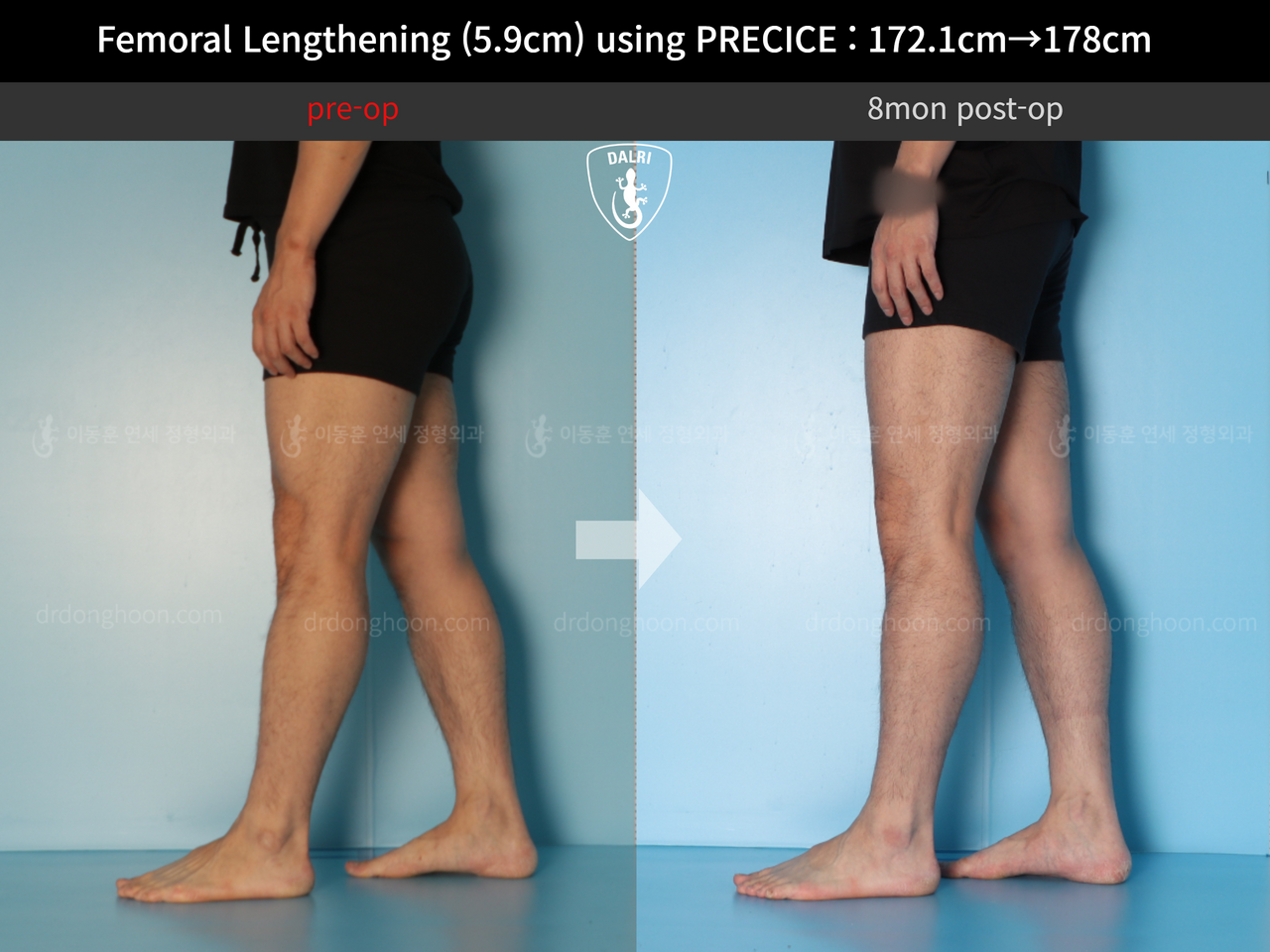 Before and after cll precice, case 13848850, image 10, Dr. Donghoon institute (DALRI)