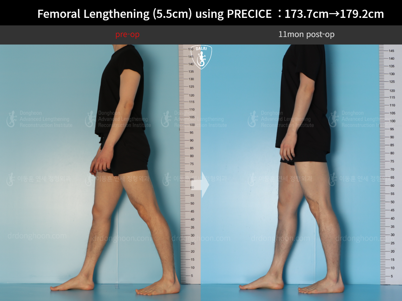 Before and after cll precice, case 18140453, image 7, Dr. Donghoon institute (DALRI)